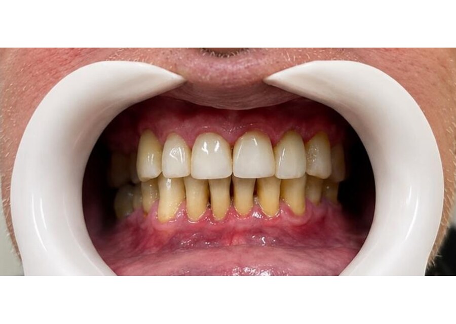 Protocolo de dentes fixos sobre implantes finalizado, reabilitação oral de boca toda em Mogi Mirim - SP