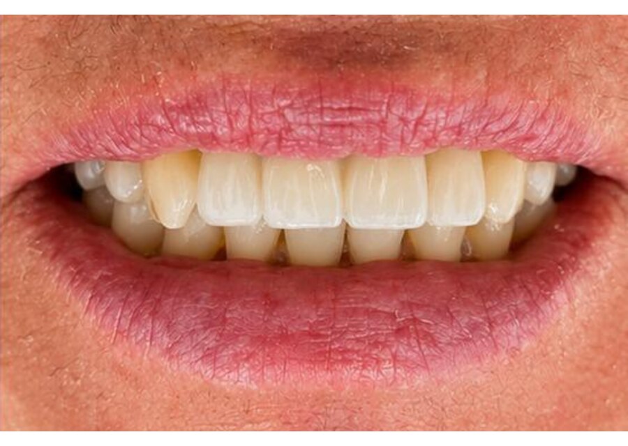 Resultado depois: dentes fixos sobre implante substituindo prótese removível em paciente do Dr. Gabriel Patricio